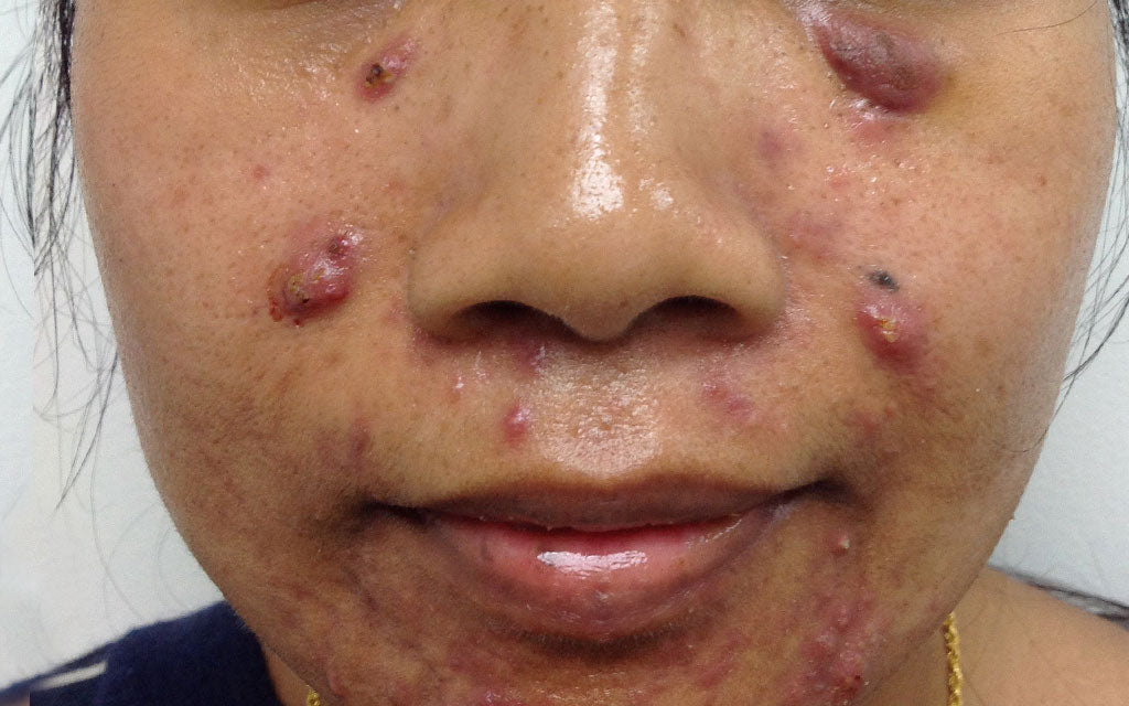 Acne Dark Skin - Before Treatment Perth K|B Karen Bowen Skin Clinic