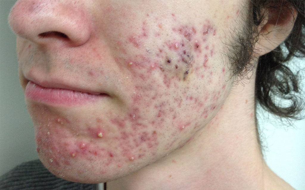 Acne Scarring Results 007 - Left - Before Treatment Karen Bowen Skin Clinic Perth