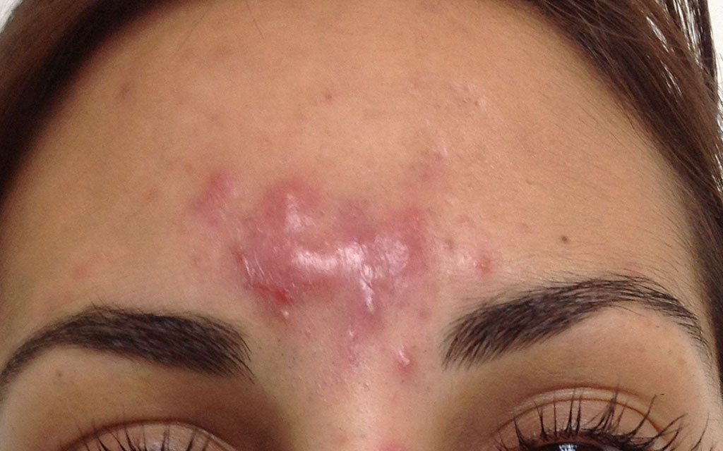 Acne Treatment 005 - Front - Before - Karen Bowen Skin Clinic Perth