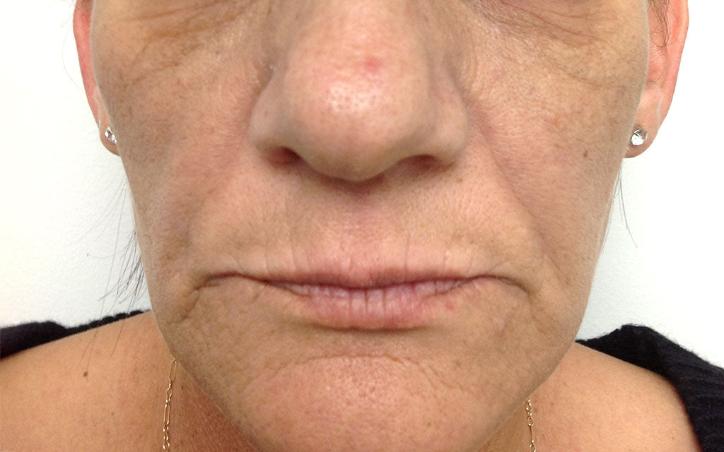 Aging Skin Treatment 001 - Front - Before Karen Bowen Skin Clinic Perth