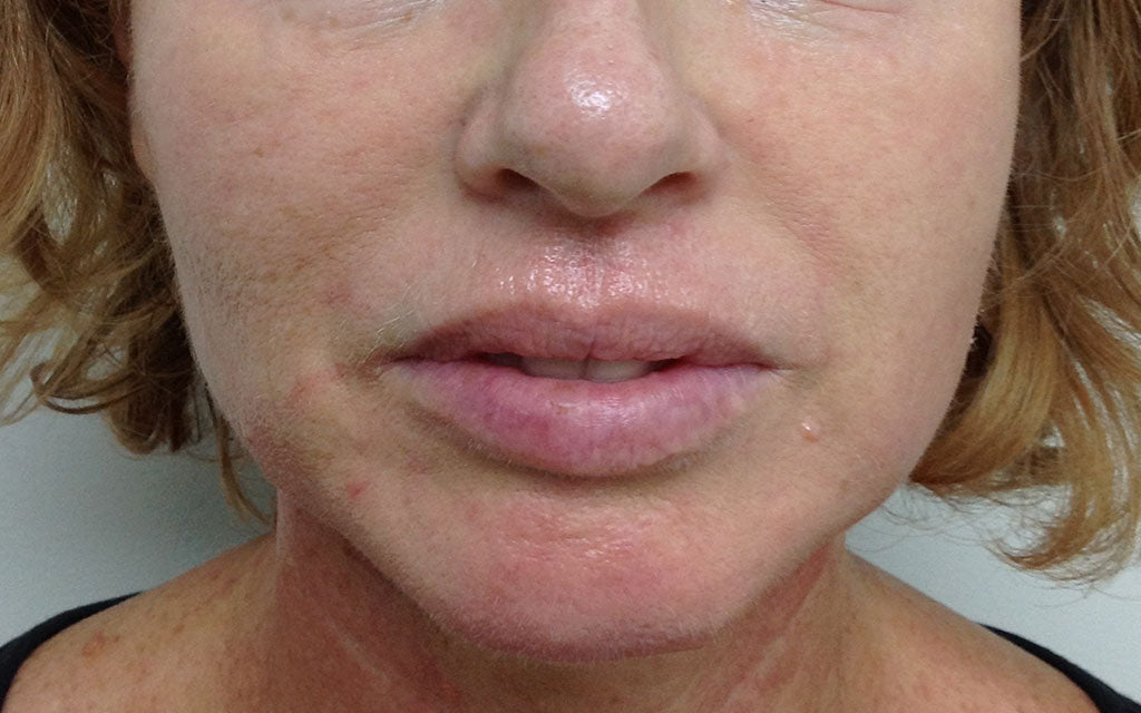 Aging Skin Treatment 004 - Front - After Karen Bowen Skin Clinic Perth