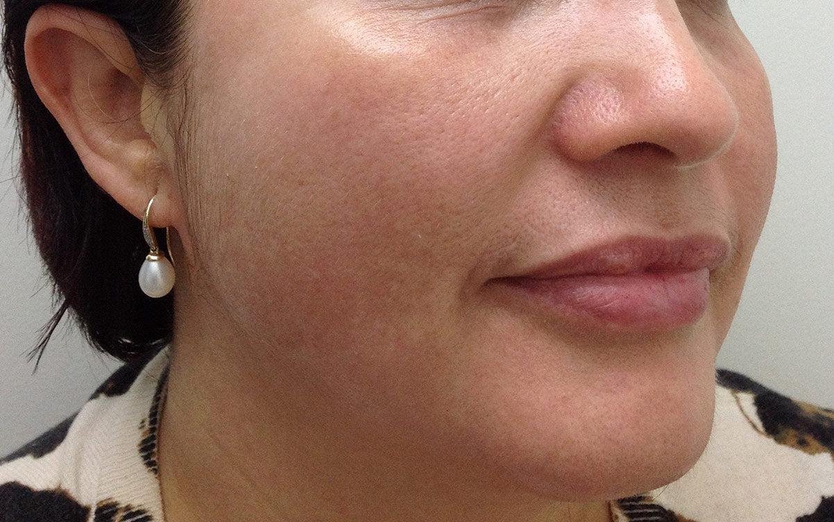 IPL Treatment Perth - Pigmentation 02 - Right - After - Karen Bowen Skin Clinic Perth