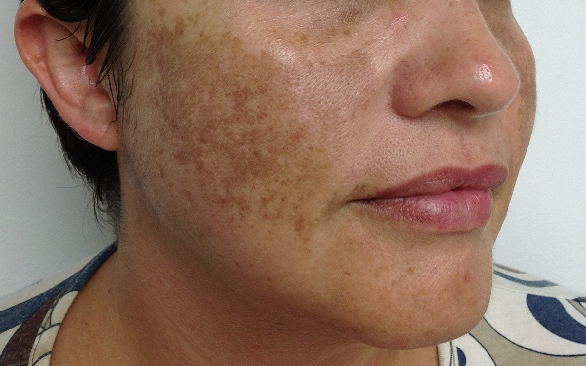 IPL Treatment Perth - Pigmentation 02 - Right - Before - Karen Bowen Skin Clinic Perth