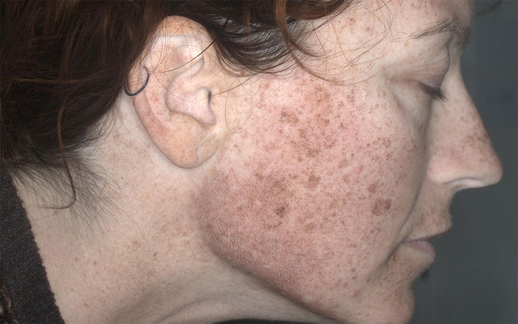 IPL Treatment Perth - Pigmentation - Right - Before - Karen Bowen Skin Clinic Perth