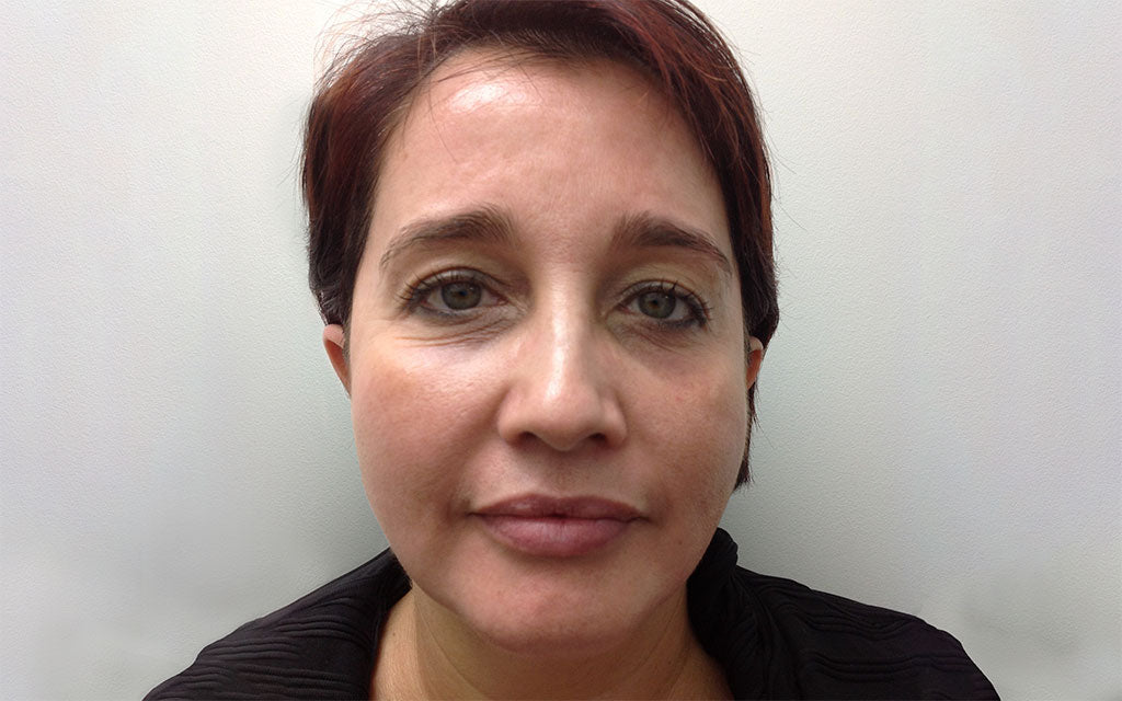 Pigmentation Treatment 002 - Front - After Karen Bowen Skin Clinic Perth