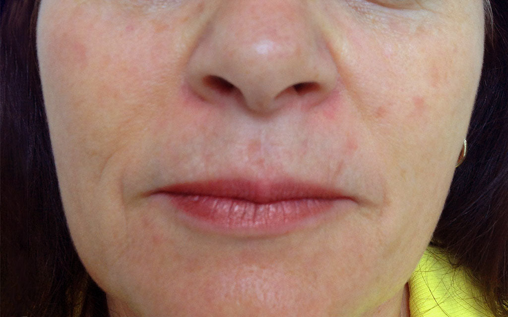 Pigmentation Treatment 005 - Front - After Karen Bowen Skin Clinic Perth