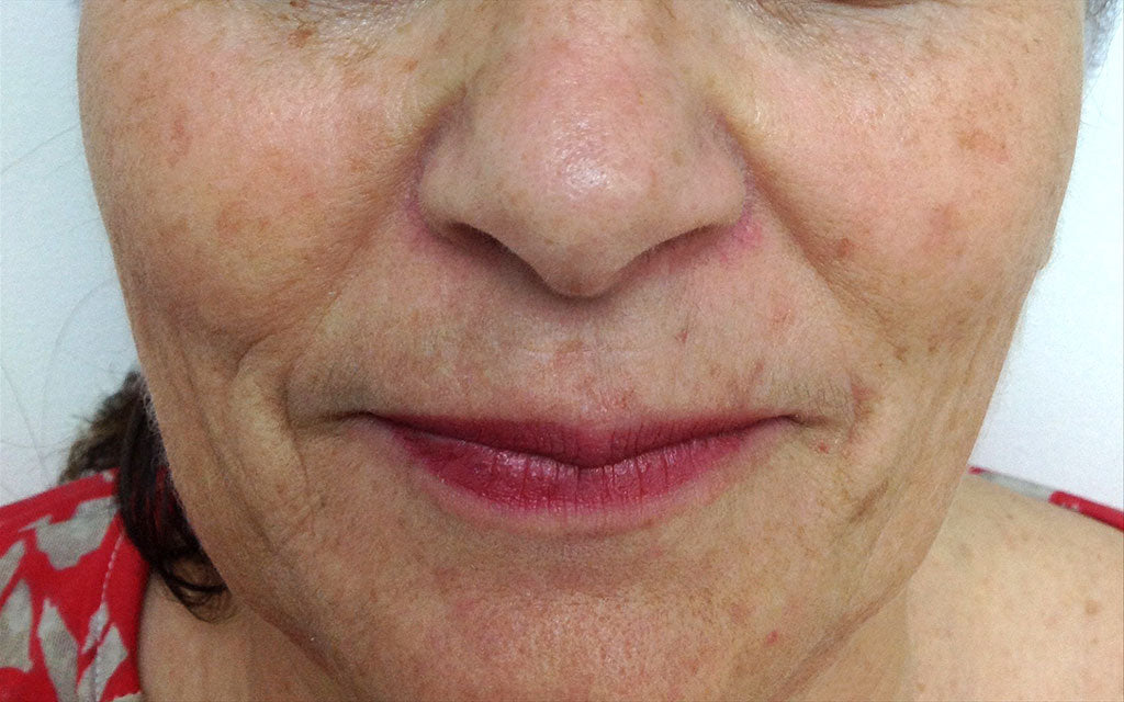 Pigmentation Treatment 005 - Front - Before Karen Bowen Skin Clinic Perth