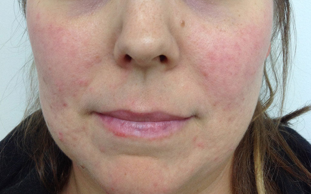 Rosacea Treatment 003 - Front - After Karen Bowen Skin Clinic Perth