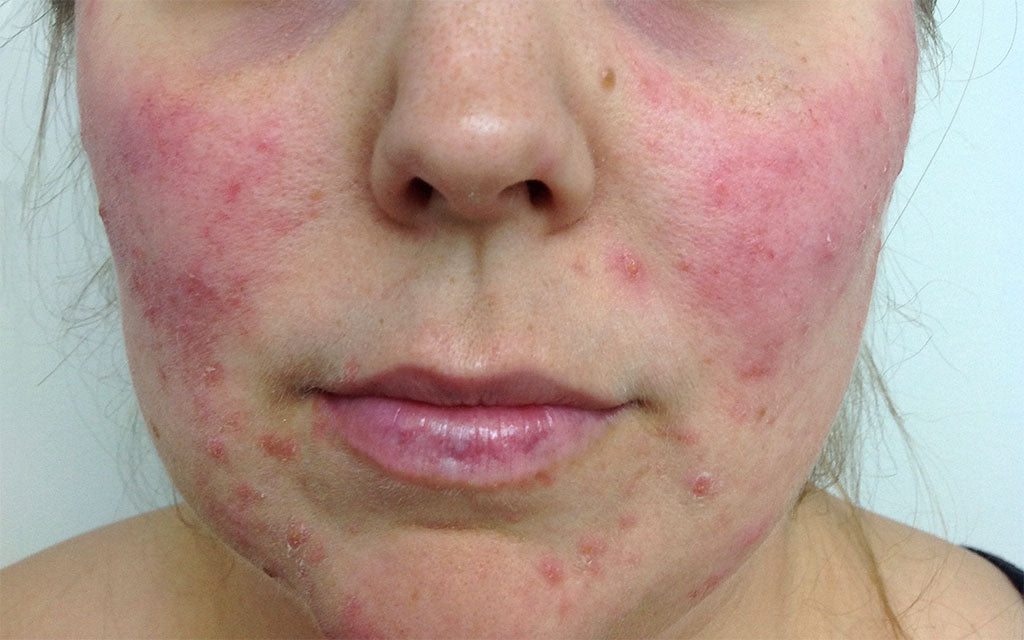 Rosacea Treatment 003 - Front - Before Karen Bowen Skin Clinic Perth