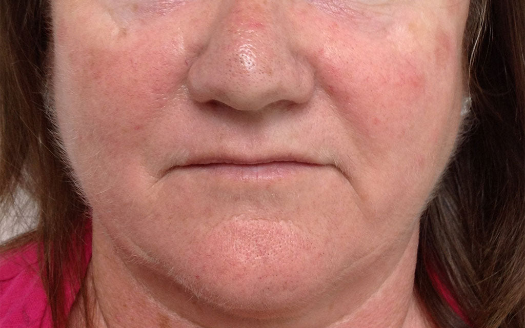 Rosacea Treatment 001 - Front - Before Karen Bowen Skin Clinic Perth