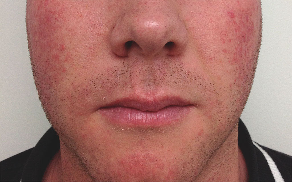 Rosacea Treatment 005 - Front - Before Karen Bowen Skin Clinic Perth