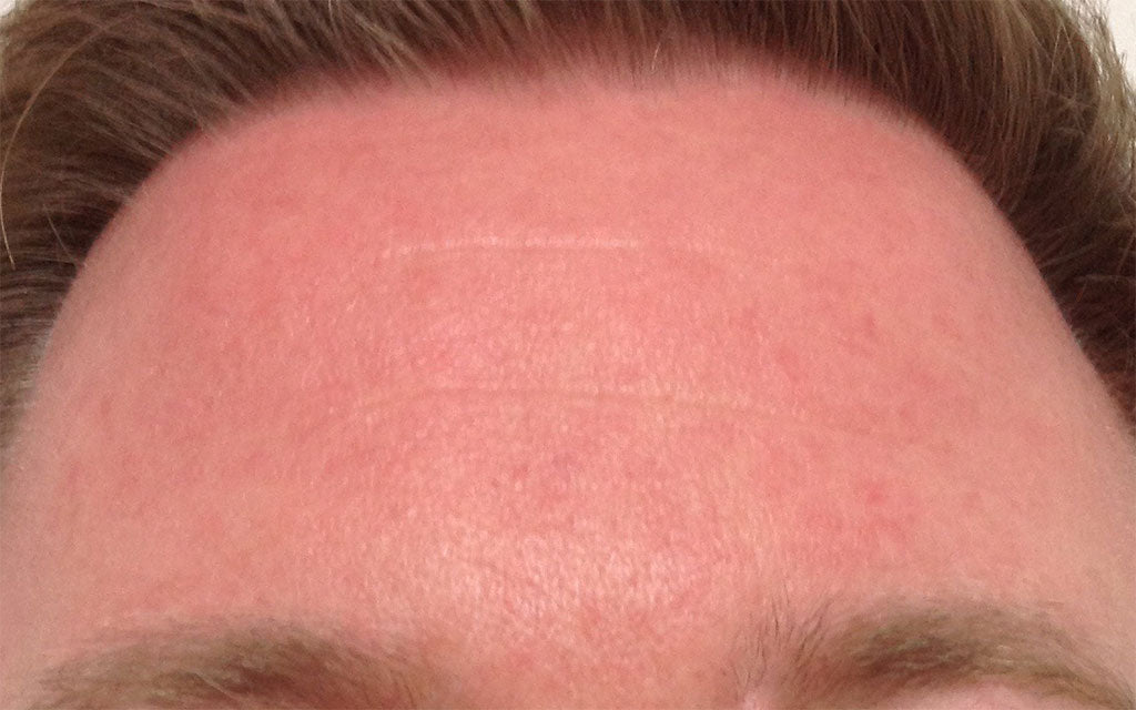 Rosacea Treatment 005 - Front - After Karen Bowen Skin Clinic Perth