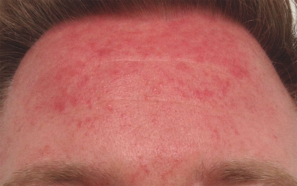 Rosacea Treatment 005 - Front - Before Karen Bowen Skin Clinic Perth