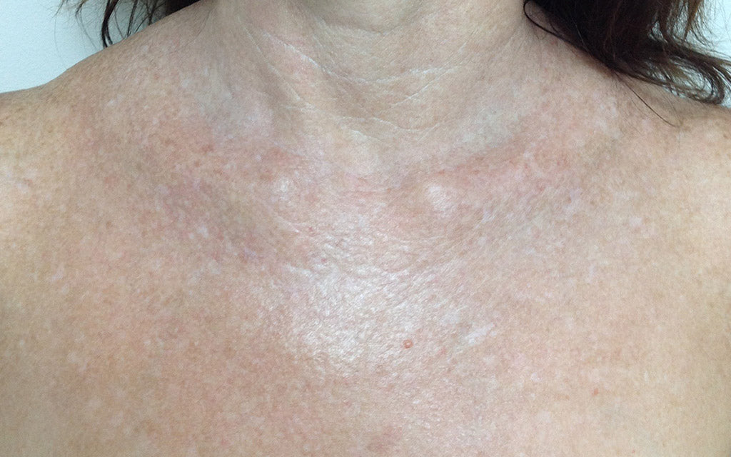 IPL Skin Rejuvination After - Karen Bowen Dermal Therapist Perth