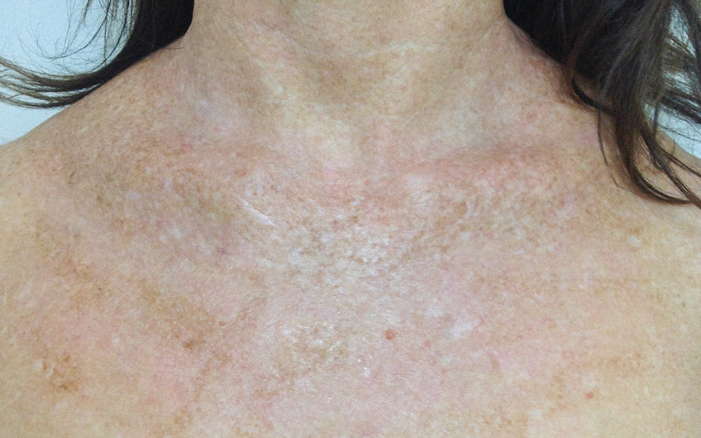 IPL Skin Rejuvination Before - Karen Bowen Dermal Therapist Perth