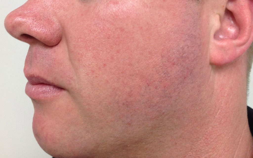 Skin Redness After Treatment Perth - K|B Karen Bowen Skin Clinic