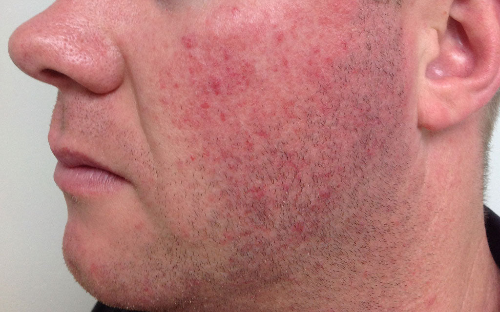 Skin Redness Before Treatment Perth - K|B Karen Bowen Skin Clinic