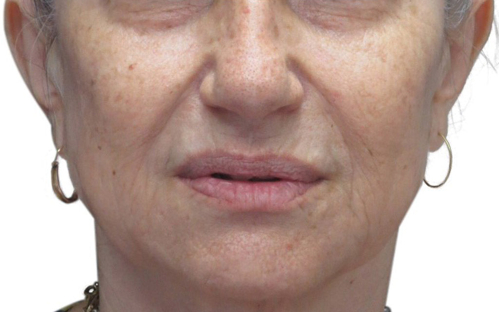 After - Venus Viva (After 3 Treatments) Skin Tightening Wrinkle Reduction Facial Rejuvination K|B Karen Bowen Skin Clinic Perth