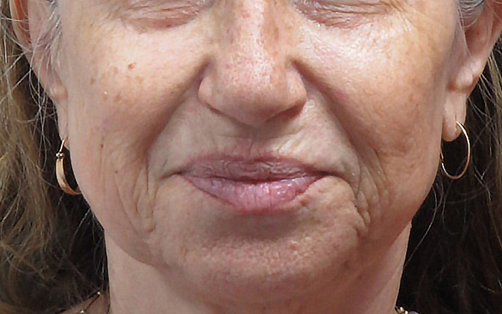 Before - Venus Viva (After 3 Treatments) Skin Tightening Wrinkle Reduction Facial Rejuvination K|B Karen Bowen Skin Clinic Perth