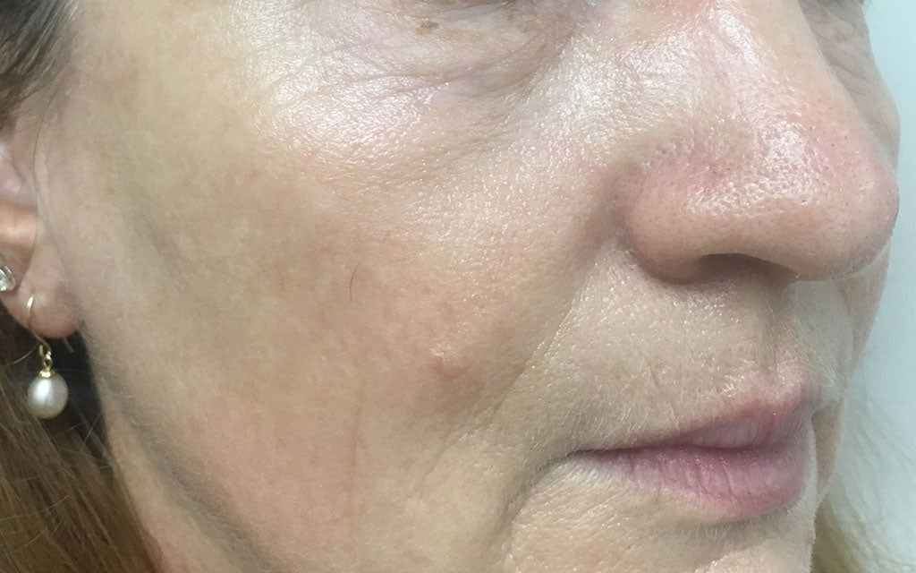 Wrinkles and Pigmentation Results 001 - Right - After Treatment Karen Bowen Skin Clinic Perth